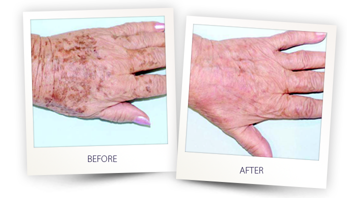 Comparison of hand appearance before and after treatment.