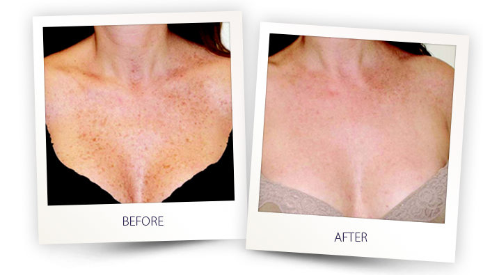 Skin improvement before and after treatment comparison.