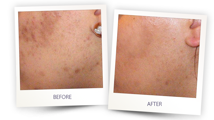 Skin improvement before and after treatment.