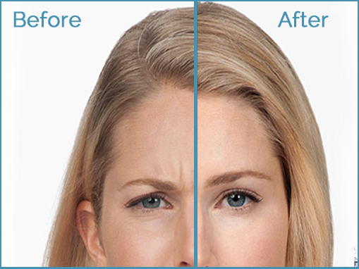 Before and after facial rejuvenation comparison.