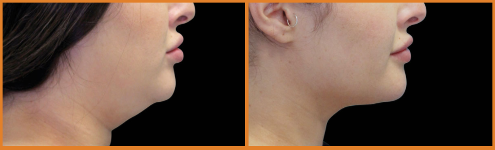 Before and after profile view comparison.