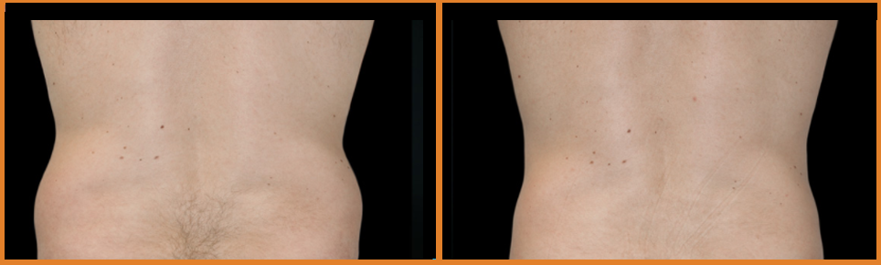 Comparison of two bare backs.