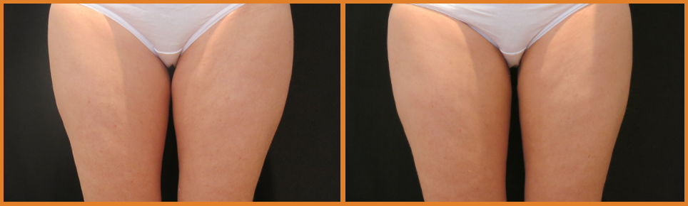 Comparison of thighs with different skin textures.