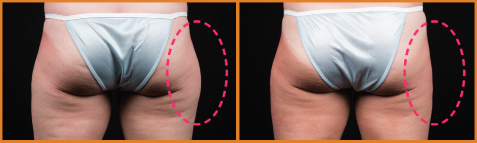 Comparison of body contouring results.