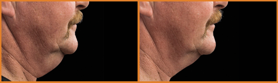 Comparison of neck profiles before and after treatment.