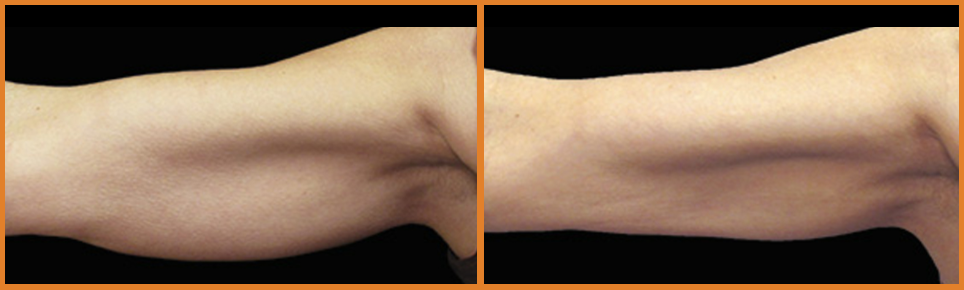 Comparison of two different arm appearances.
