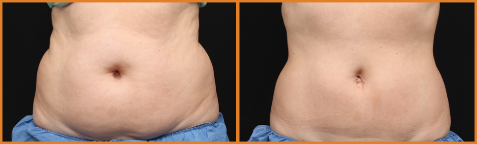 Before and after body transformation comparison.