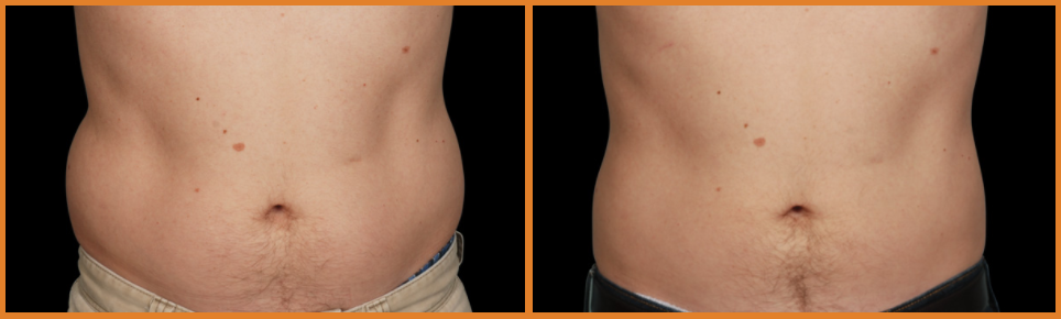 Comparison of male stomachs before and after.