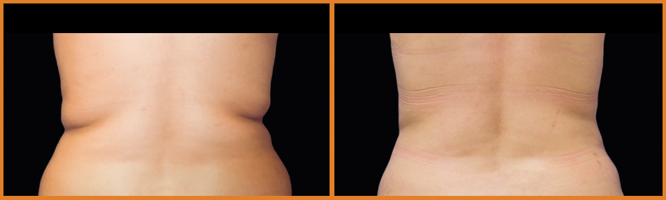 Before and after body contouring comparison.