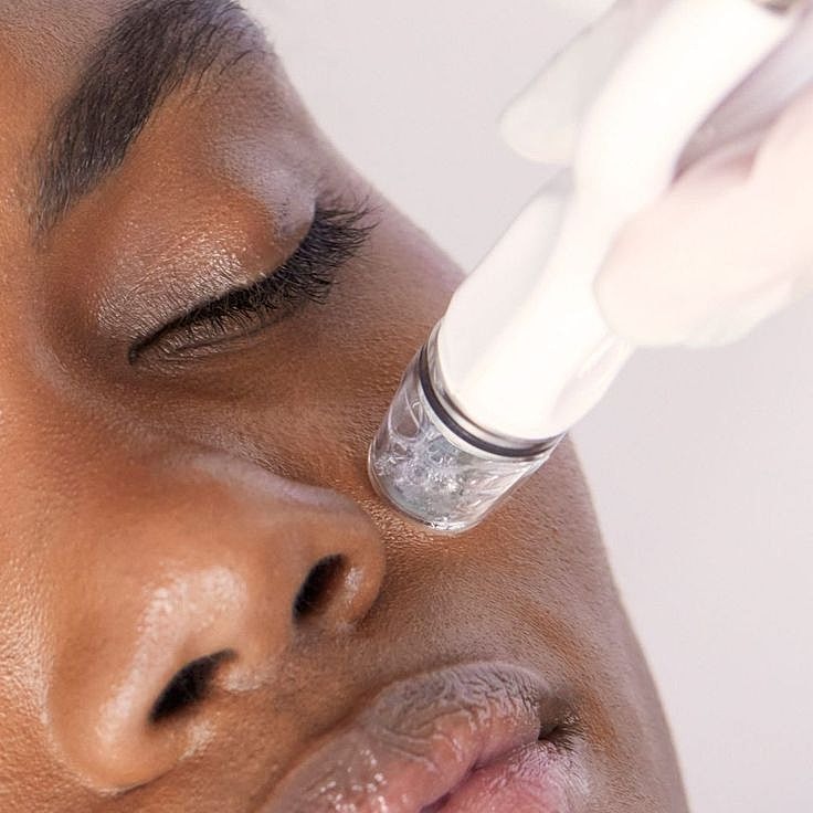 Facial treatment with a microneedling device.