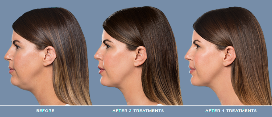 Treatment progress showing improvement in appearance.