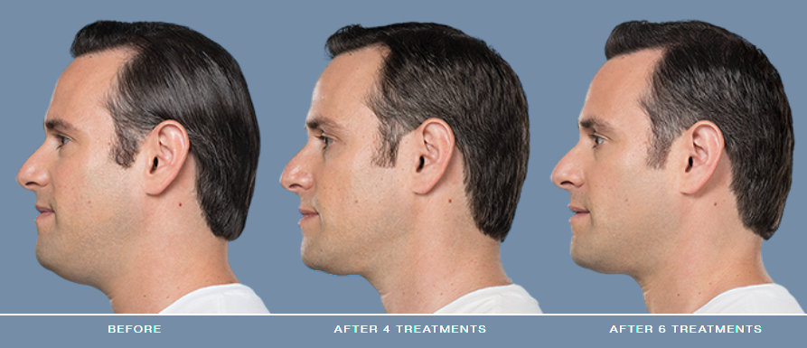 Hair treatment results after multiple sessions.