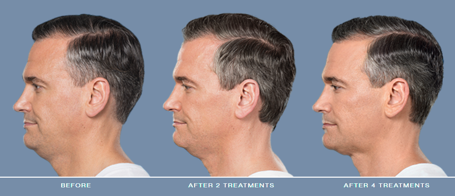 Hair transformation progress after multiple treatments.