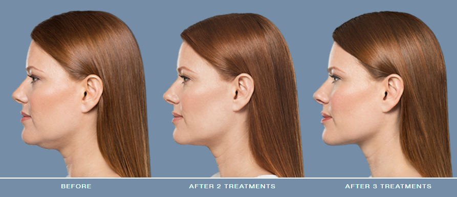 Side profile before and after treatment comparisons.