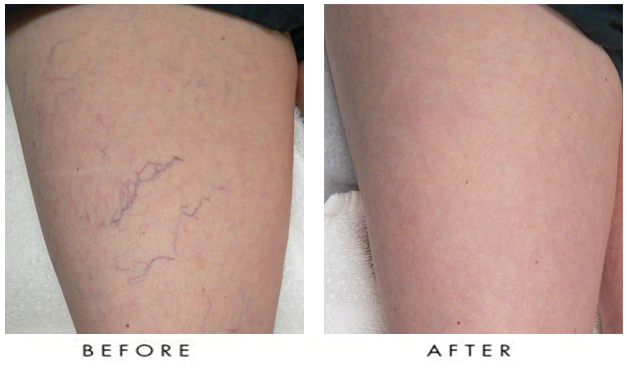 Leg appearance improvement before and after treatment.