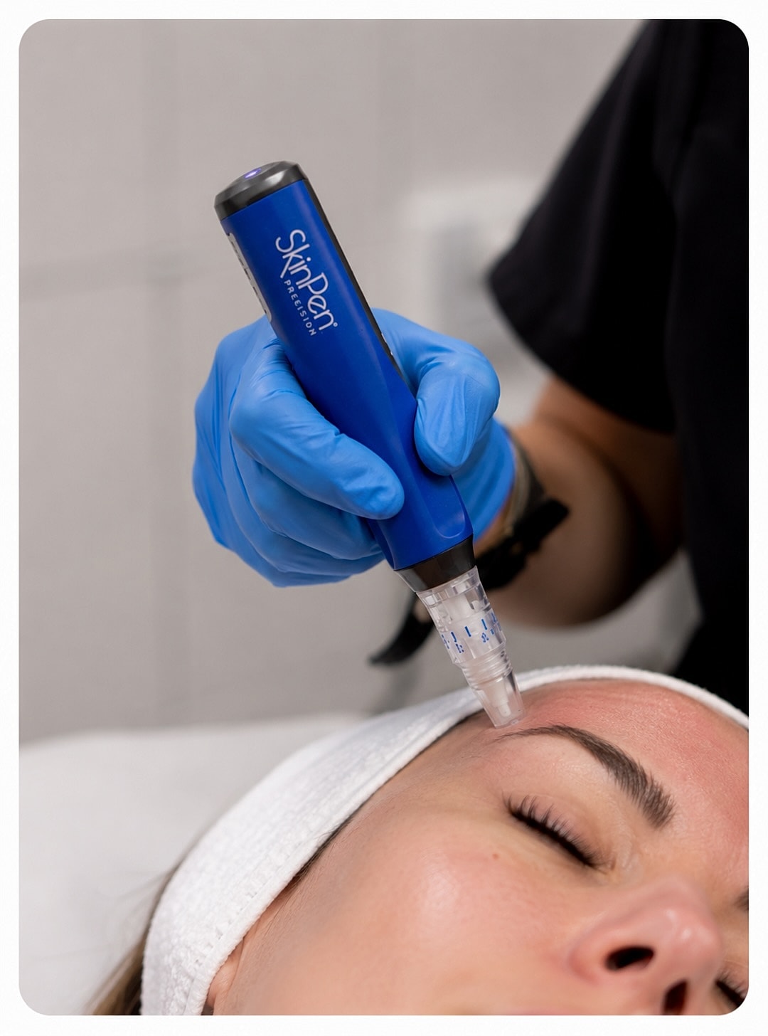 Microneedling procedure with SkinPen on client's forehead.