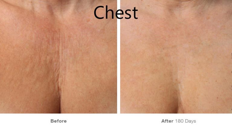 Chest skin improvement before and after treatment.