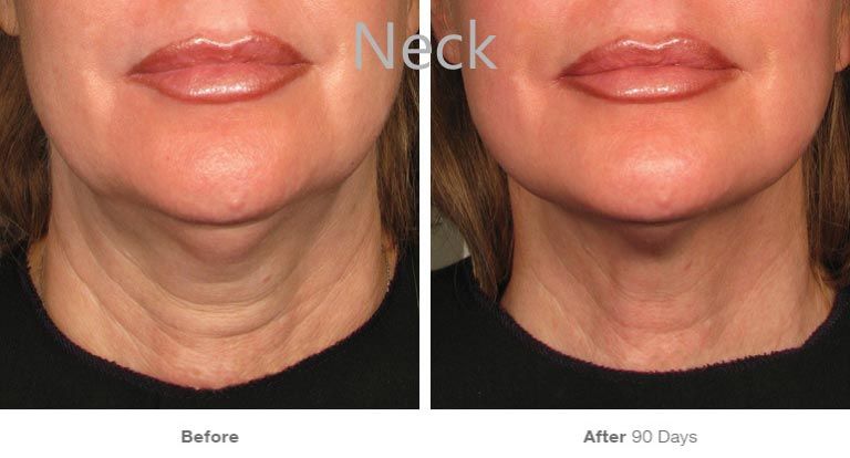 Neck treatment results: before and after comparison.