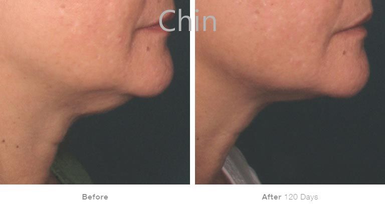 Chin transformation before and after 120 days.