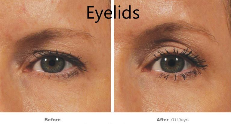 Eyelid improvement before and after 70 days