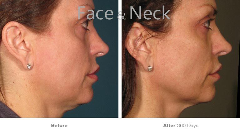 Before and after facial appearance comparison