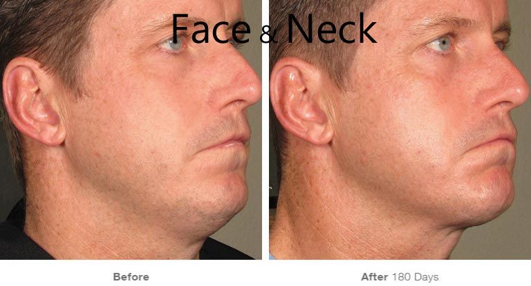 Before and after facial transformation comparison.