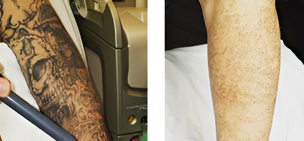 Tattoo removal process before and after comparison.