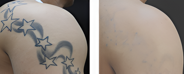 Tattooed shoulder with star designs and skin.