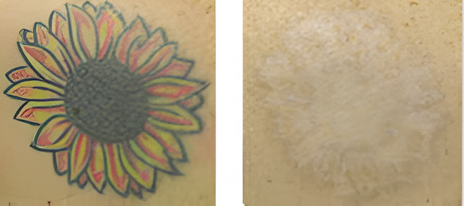 Sunflower tattoo next to faded skin area.