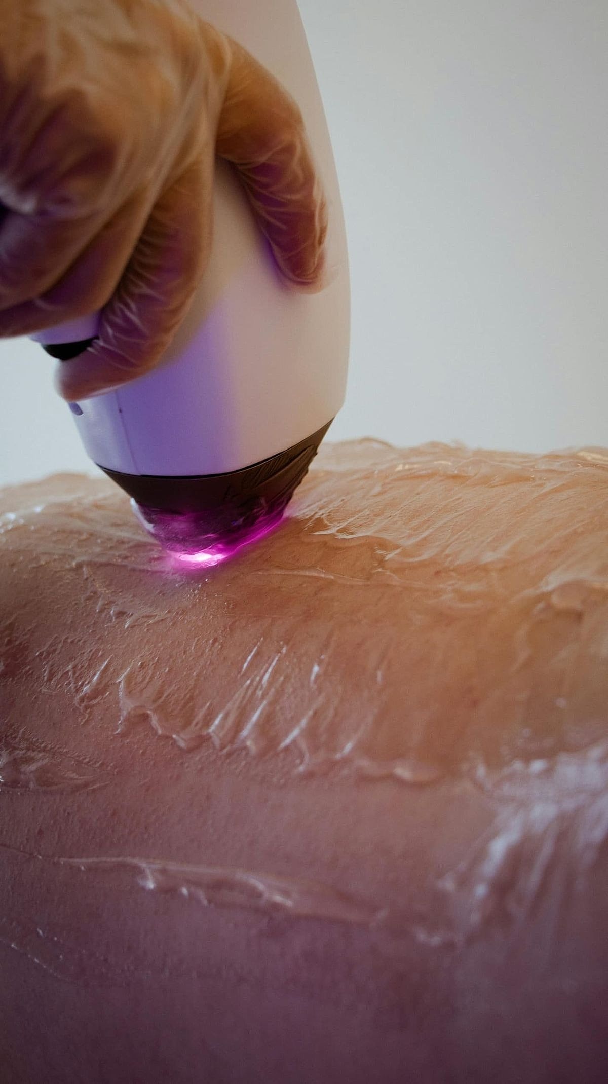 Laser treatment being performed on skin surface.